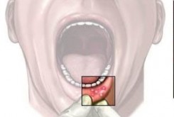نفش سن و جنسيت در ابتلا به سرطان دهان