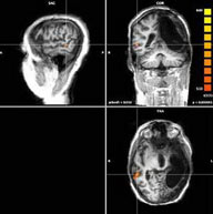 مغز انسان در صورت آسیب، اطلاعات را به نیمکره دیگر منتقل می کند