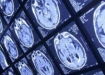 پنج واقعیت در مورد تومورهای مغزی