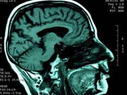 محققان هشدار دادند: موج ابتلا به سکته مغزی به جوان ترها رسیده است