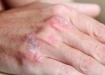 7 علامتی که زنگ خطر ابتلا به «سرطان پوست» هستند