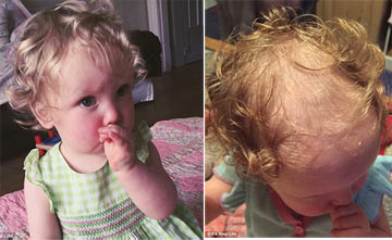 کوچکترین فرد مبتلا به وسواس اجباری کندن موی سر در دنیا+عکس