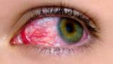 علت قرمزشدن سفیدی چشم
