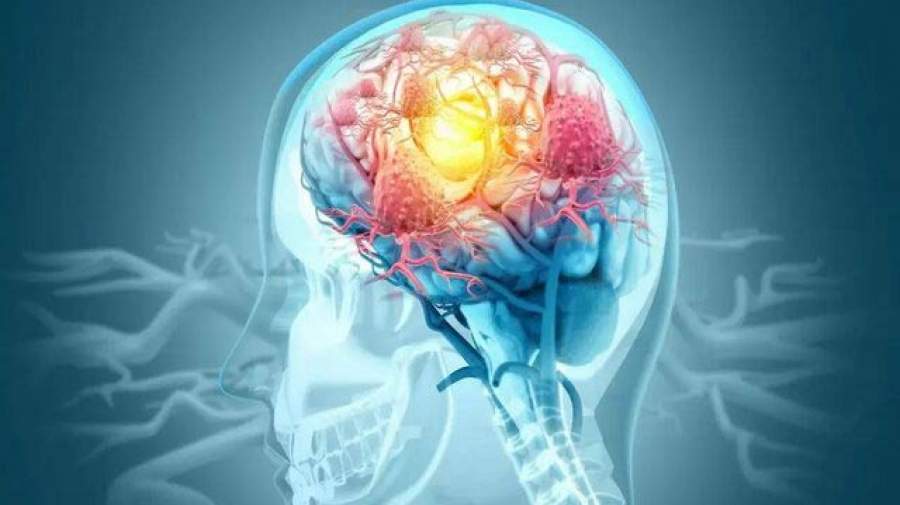 درمان موفق صرع با تزریق نورون به مغز